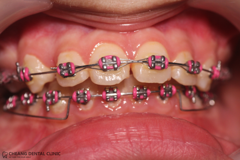 braces-conventional