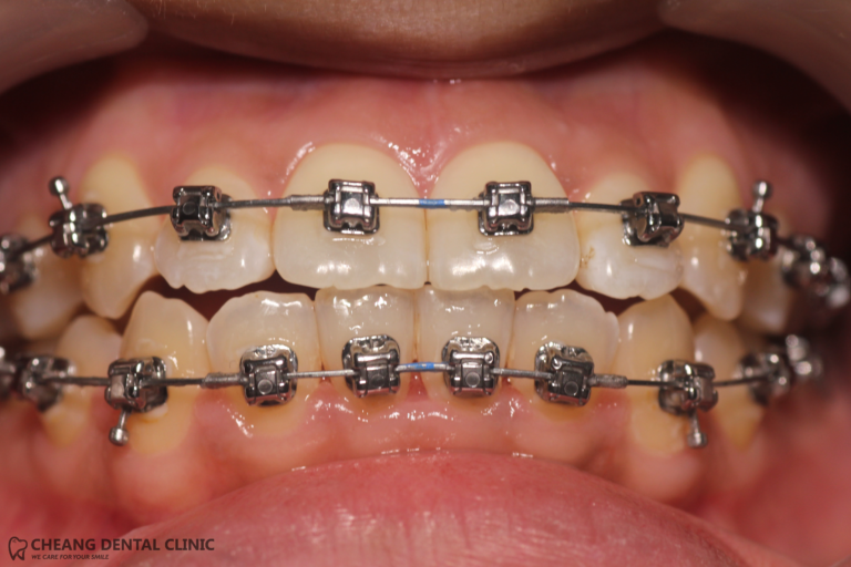 braces-self-ligating-damon-q