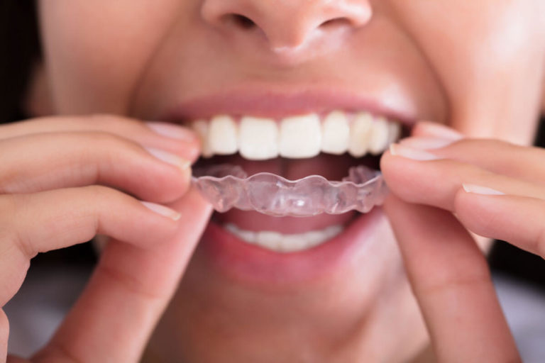 invisalign