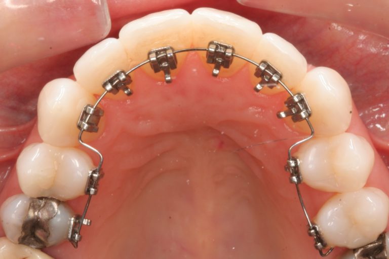 lingual-braces